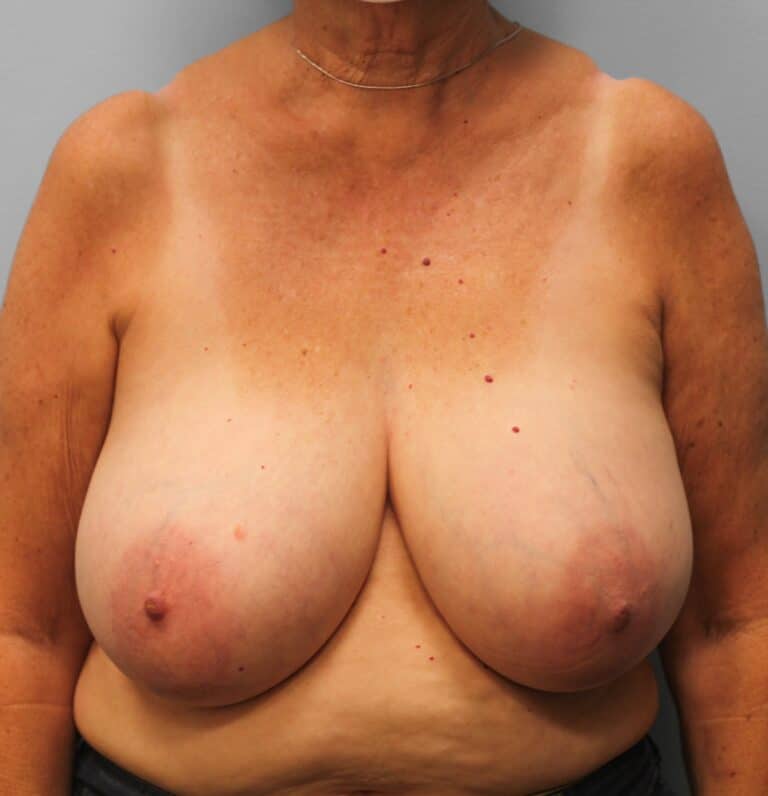 Before Image: Breast Reduction – Dr. Howell - front