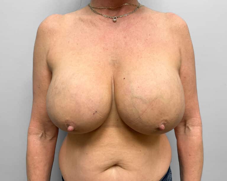 Before Image: Breast Lift and Implant Removal – Dr. Howell - front