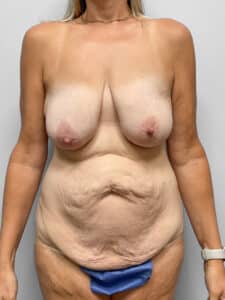 Before Image: Mommy Makeover – Dr. Howell