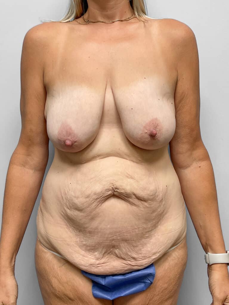 Before Image: Mommy Makeover – Dr. Howell - front