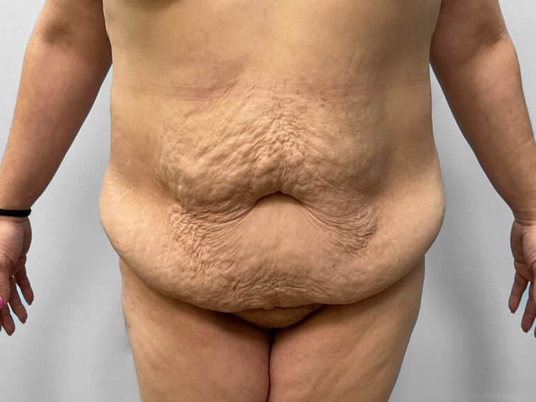 Before Image: Tummy Tuck – Dr. Howell - front