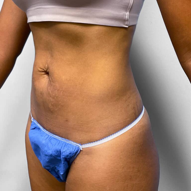 Before Image: Umbilical Float Tummy Tuck – Dr. Howell - left-front-oblique