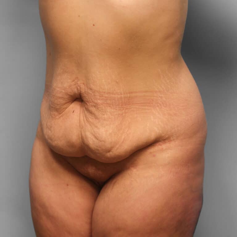 Before Image: Abdominoplasty – Dr. Howell - left-front-oblique