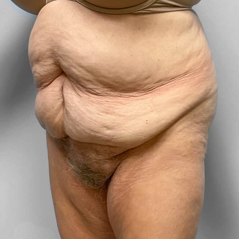 Before Image: Abdominoplasty – Dr. Howell - left-front-oblique