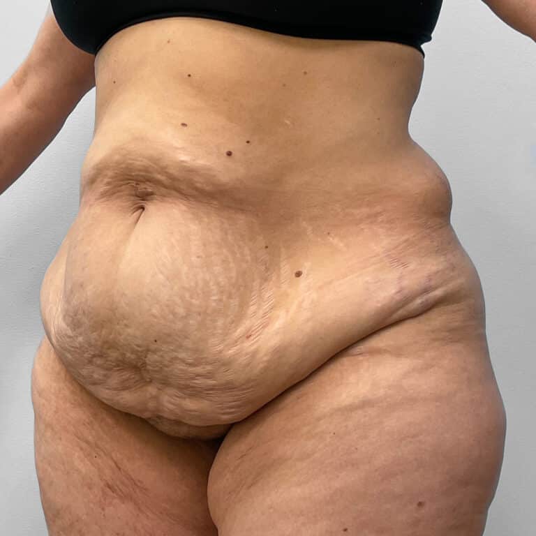 Before Image: Mommy Makeover – Dr. Howell - left-front-oblique