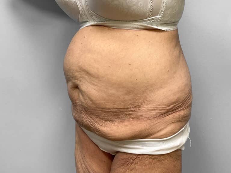 Before Image: Tummy Tuck – Dr. Howell - left-front-oblique