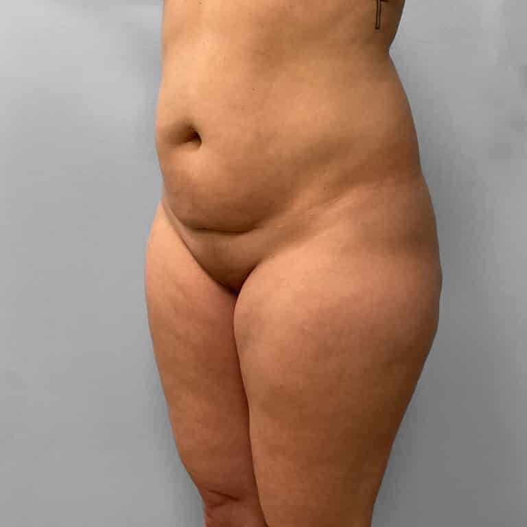 Before Image: Liposuction – Dr. Howell - left-front-oblique