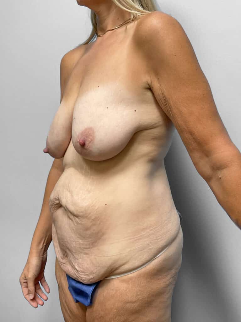Before Image: Mommy Makeover – Dr. Howell - left-front-oblique