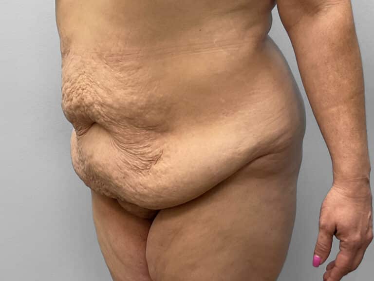 Before Image: Tummy Tuck – Dr. Howell - left-front-oblique