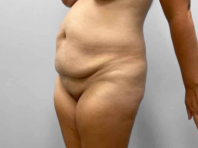 Before Image: Tummy Tuck – Dr. Howell - left-front-oblique