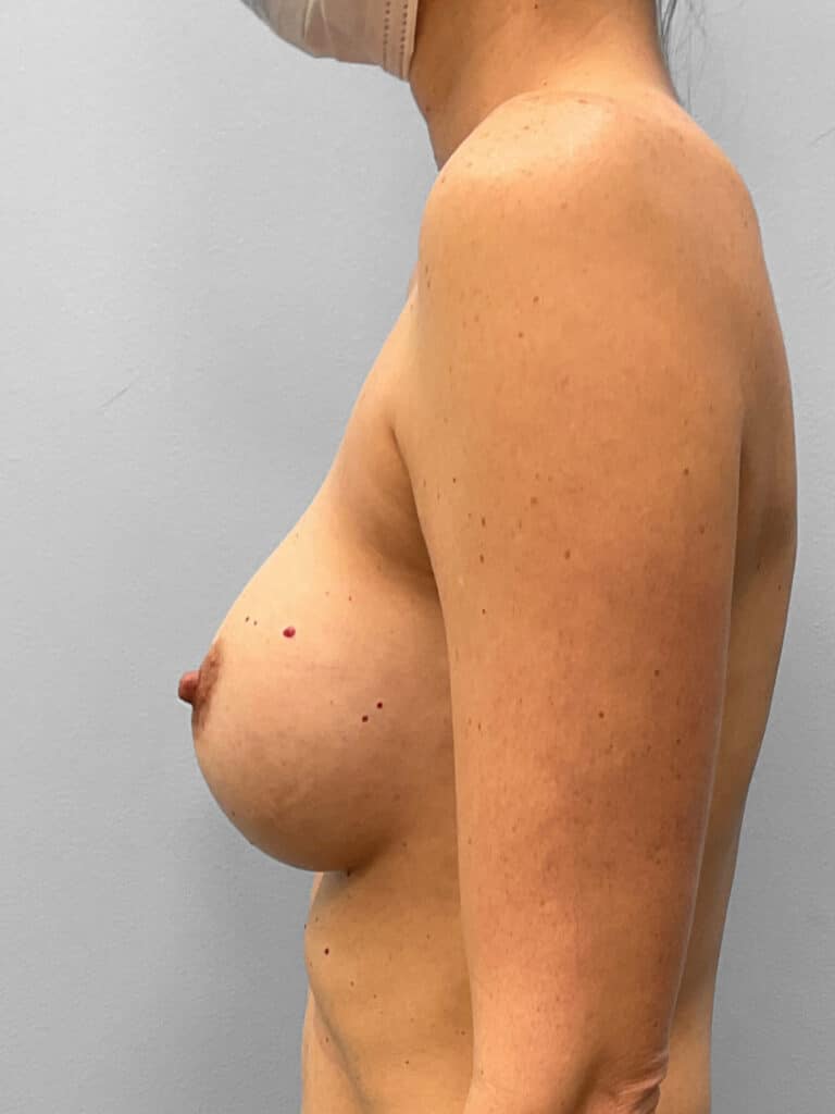 Before Image: Breast Implant Removal – Dr. Howell - left-side