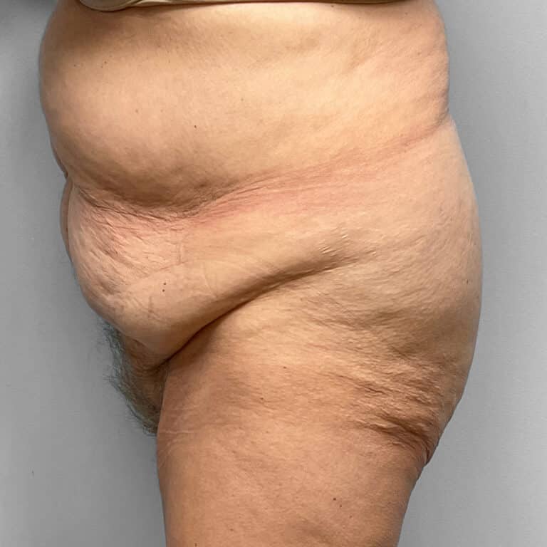 Before Image: Abdominoplasty – Dr. Howell - left-side