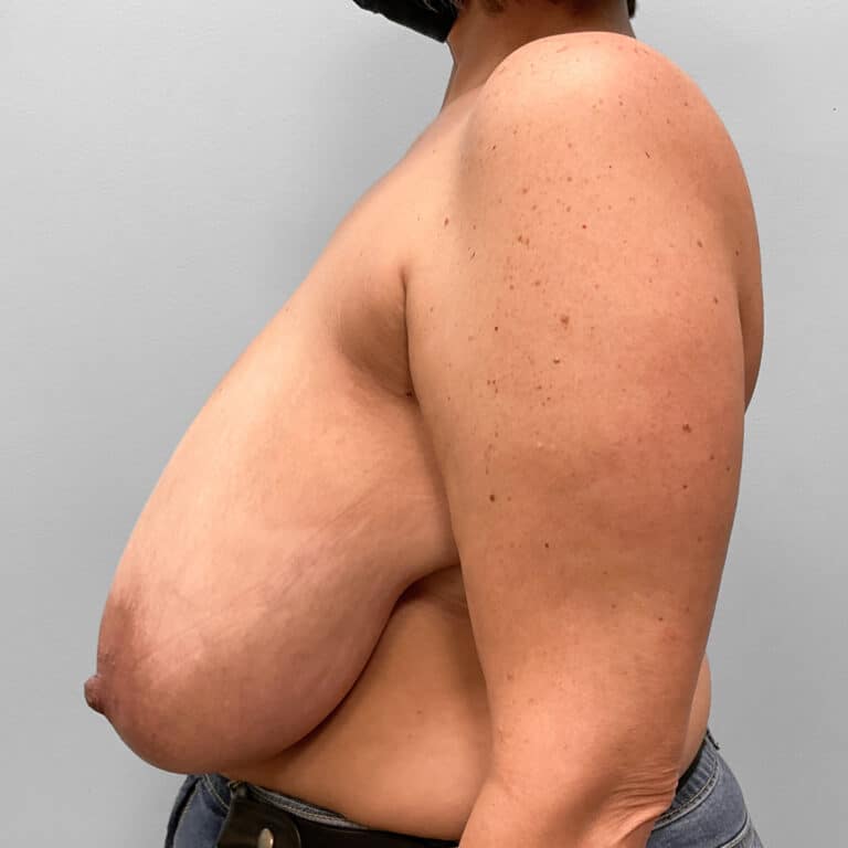 Before Image: Mommy Makeover – Dr. Howell - left-side