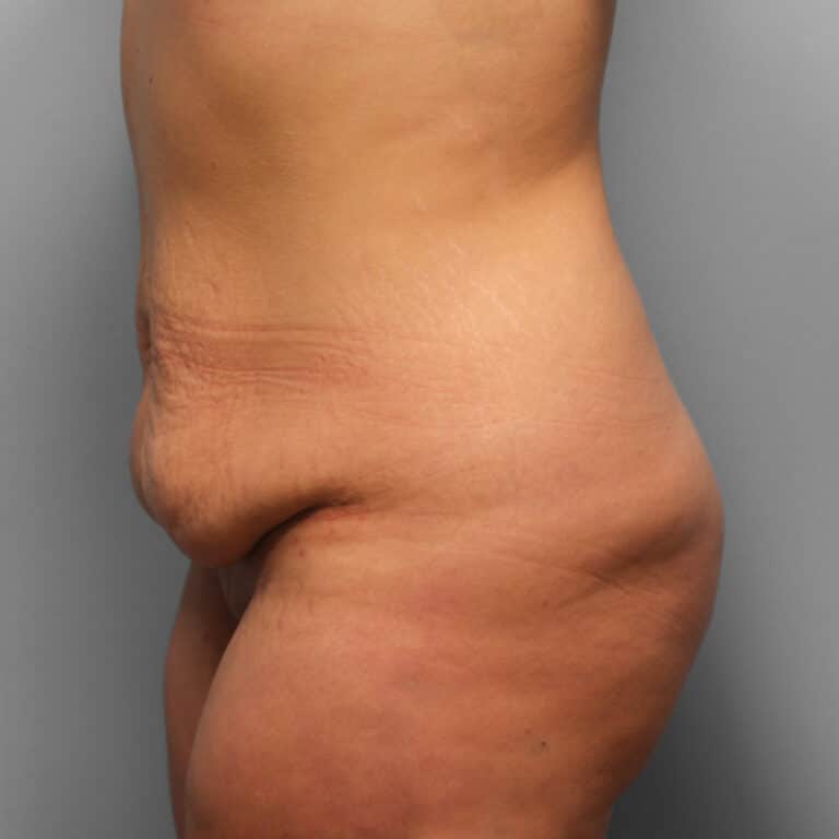Before Image: Abdominoplasty – Dr. Howell - left-side