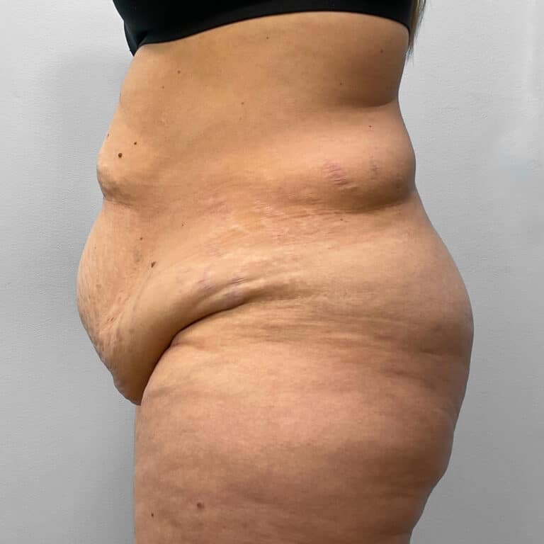 Before Image: Mommy Makeover – Dr. Howell - left-side