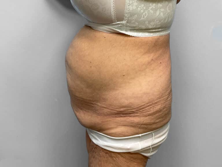 Before Image: Tummy Tuck – Dr. Howell - left-side