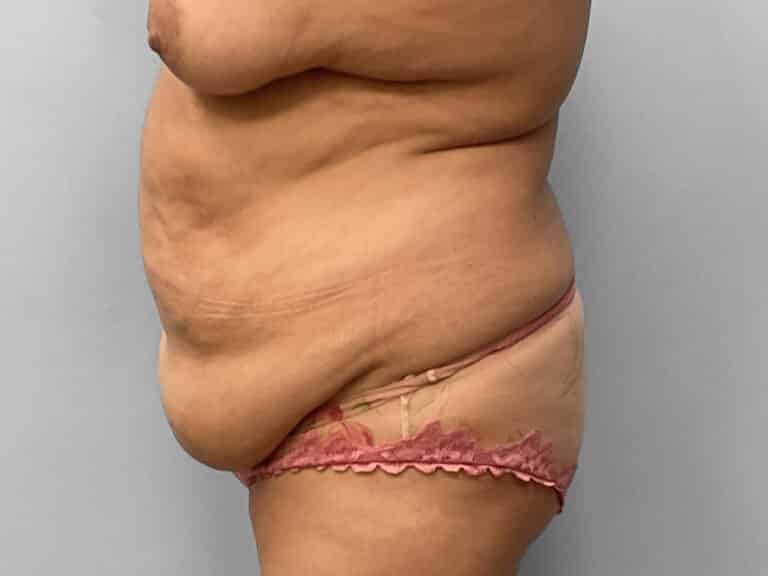 Before Image: Abdominoplasty – Dr. Howell - left-side