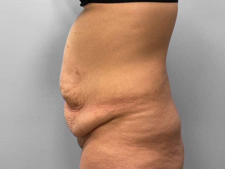 Before Image: Abdominoplasty – Dr. Howell - left-side