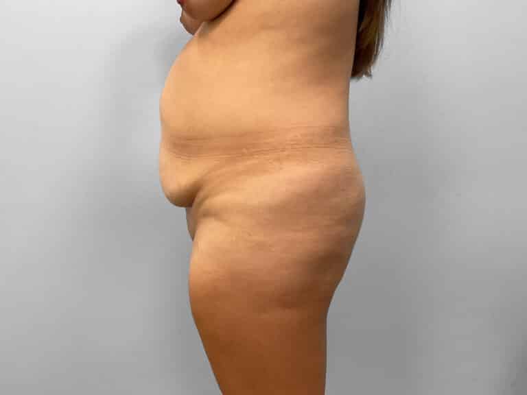 Before Image: Tummy Tuck – Dr. Howell - left-side