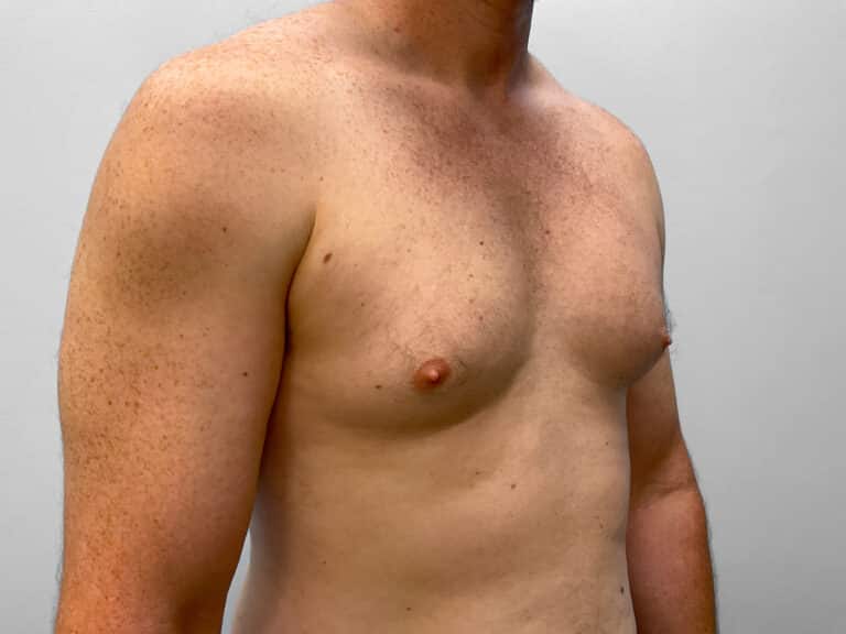 Before Image: Gynecomastia Correction – Dr. Howell - right-front-oblique