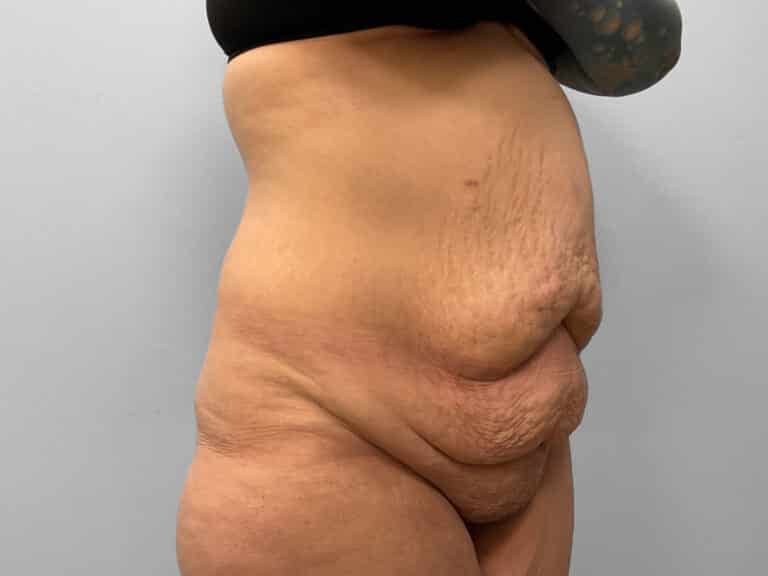 Before Image: Abdominoplasty – Dr. Howell - right-front-oblique