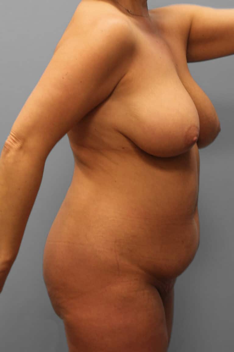 Before Image: Mommy Makeover – Dr. Howell - right-front-oblique