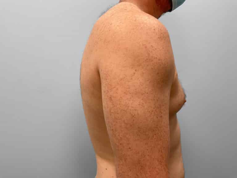 Before Image: Gynecomastia Correction – Dr. Howell - right-side