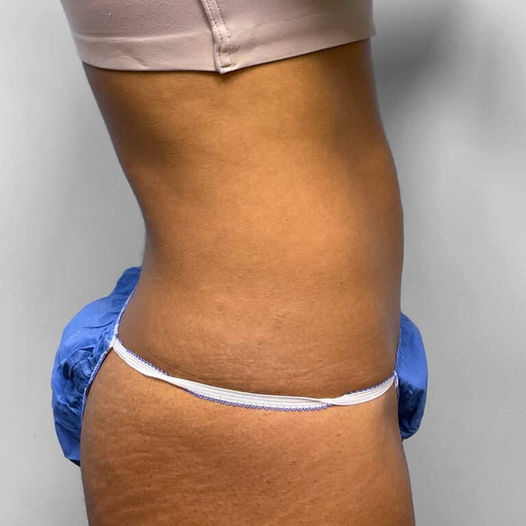 Before Image: Umbilical Float Tummy Tuck – Dr. Howell - right-side