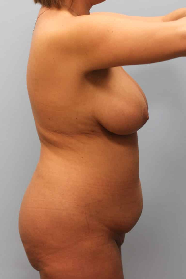 Before Image: Mommy Makeover – Dr. Howell - right-side
