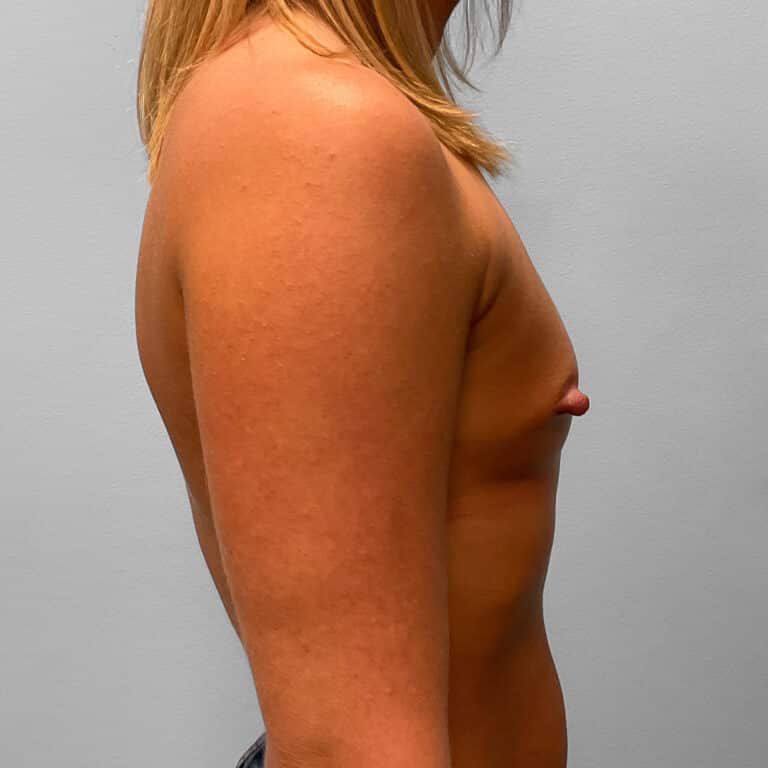 Before Image: Breast Augmentation – Dr. Howell - right-side