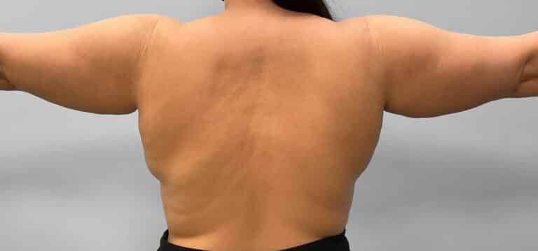 Before Image: Liposuction – Dr. Howell - back