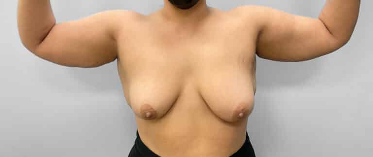 Before Image: Liposuction – Dr. Howell - front