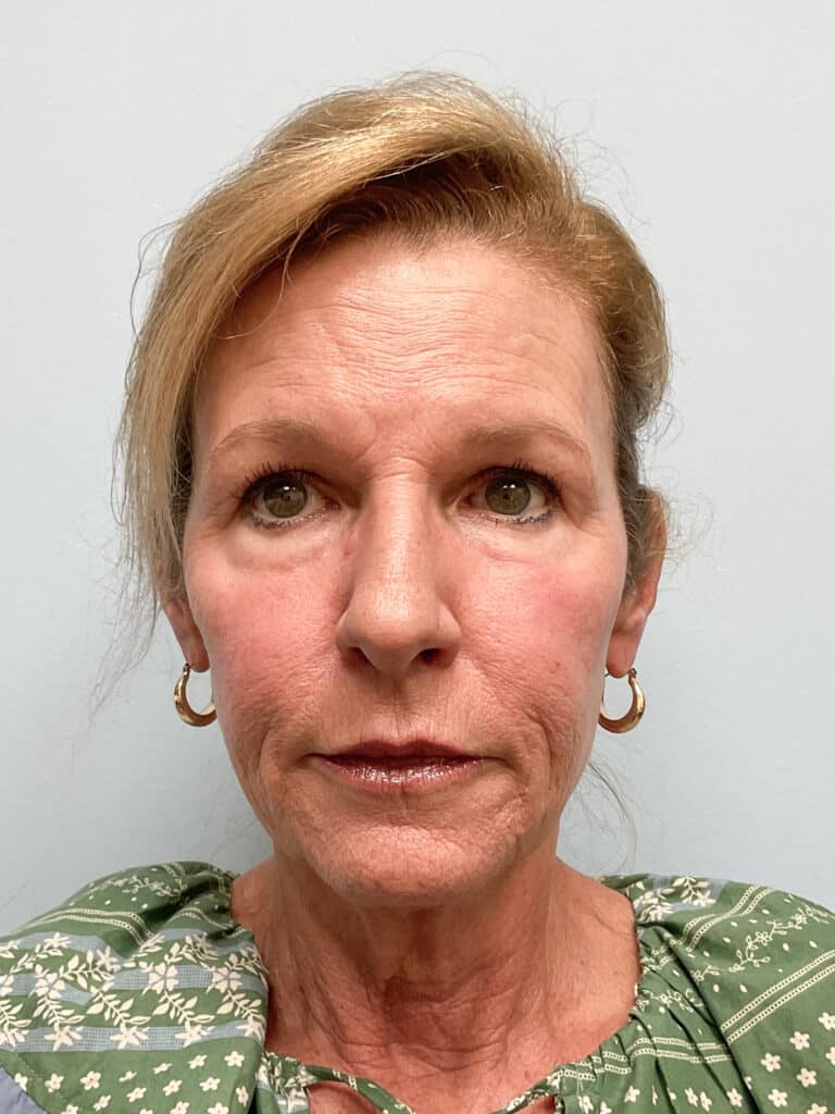 After Image: Laser Resurfacing – Dr. Tucker -