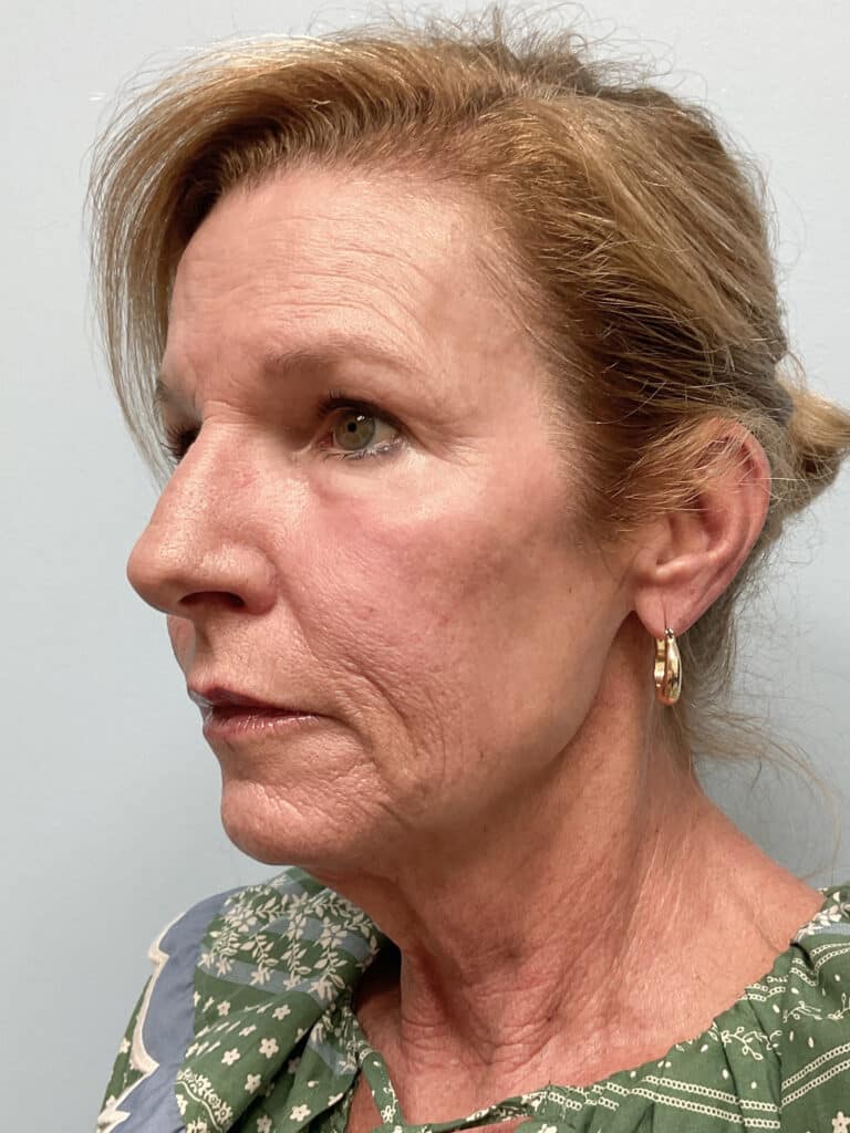 After Image: Laser Resurfacing – Dr. Tucker - left-front-oblique