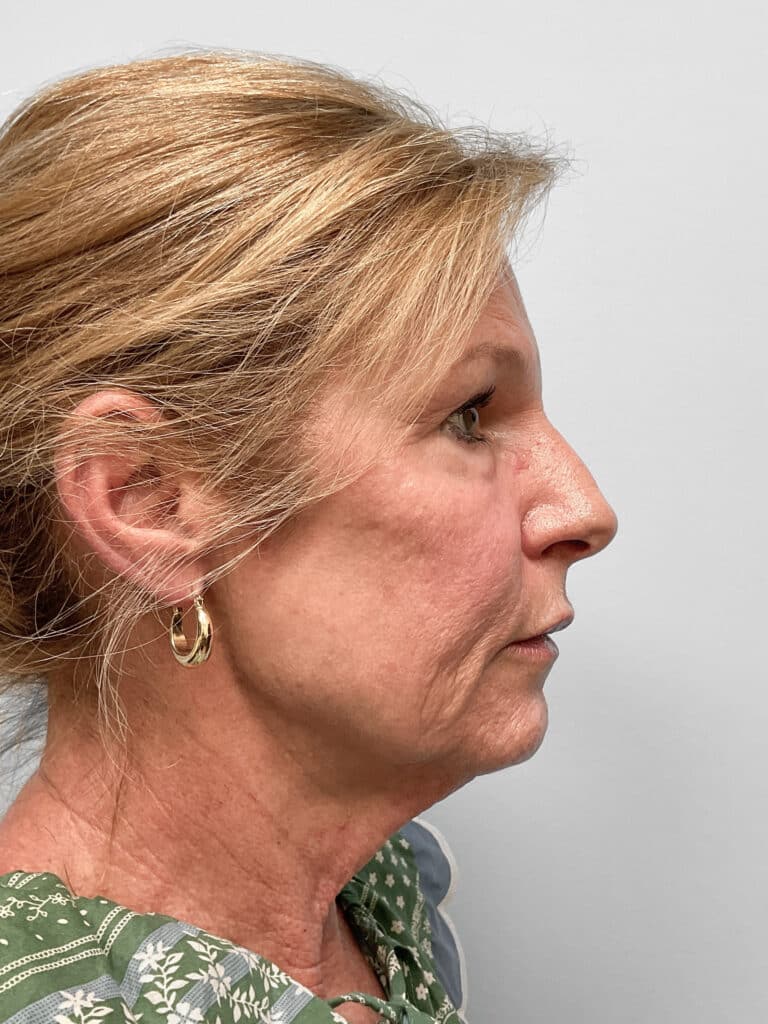 After Image: Laser Resurfacing – Dr. Tucker - right-side