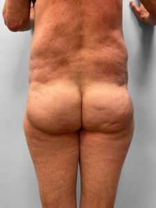 After Image: BBL & Lipo – Dr. Tucker