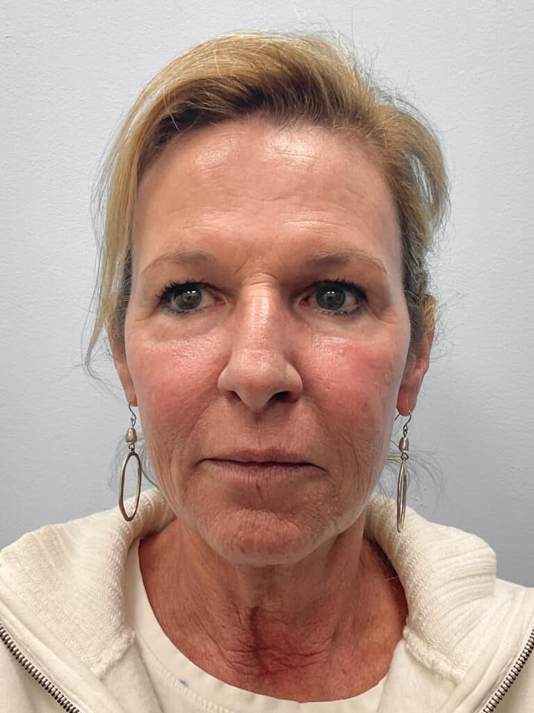 After Image: Laser Resurfacing – Dr. Tucker - front