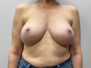 After Image: Breast Implant Exchange – Dr. Tucker