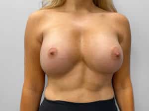 After Image: Breast Augmentation – Dr. Tucker