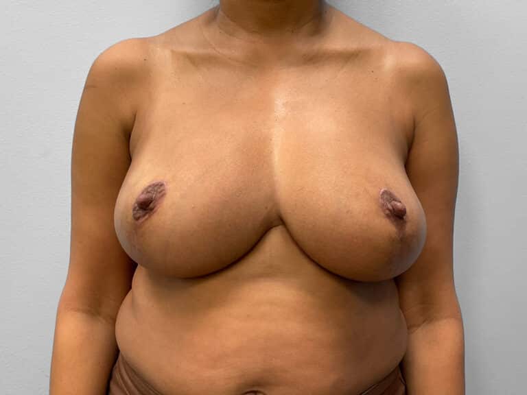 After Image: Breast Reduction – Dr. Tucker - front