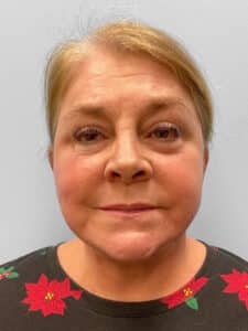 After Image: Facelift & Laser Resurfacing – Dr. Tucker