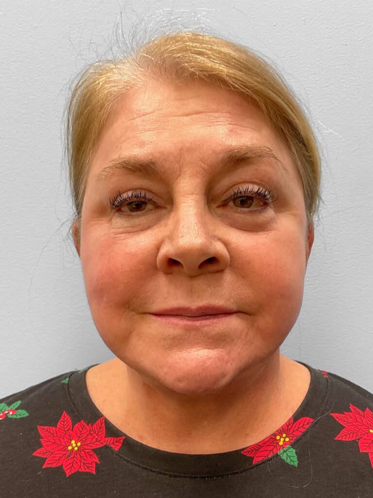 After Image: Facelift & Laser Resurfacing – Dr. Tucker - front
