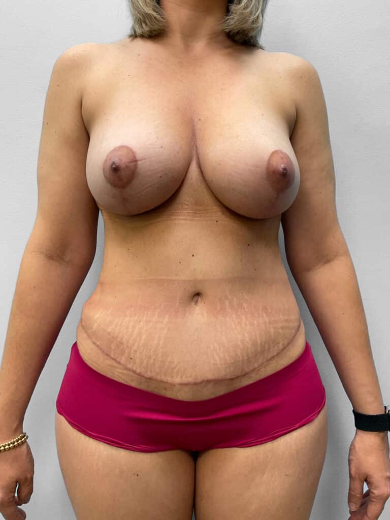 After Image: Mommy Makeover – Dr. Tucker - front