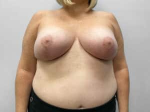 After Image: Breast Augmentation & Lift – Dr. Tucker