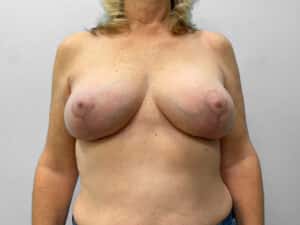 After Image: Breast Implant Removal & Lift – Dr. Tucker