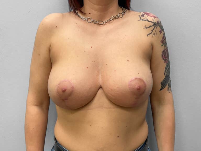After Image: Breast Augmentation & Lift – Dr. Tucker - front