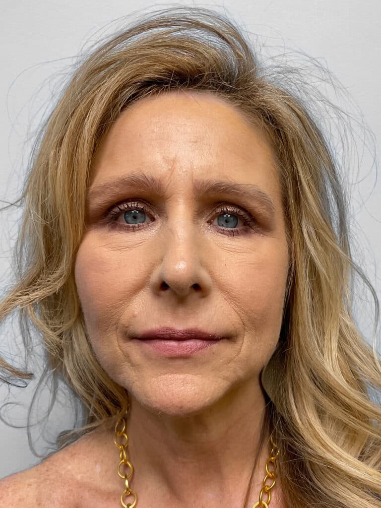 After Image: Rhinoplasty – Dr. Tucker - front