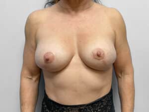 After Image: Breast Augmentation – Dr. Tucker
