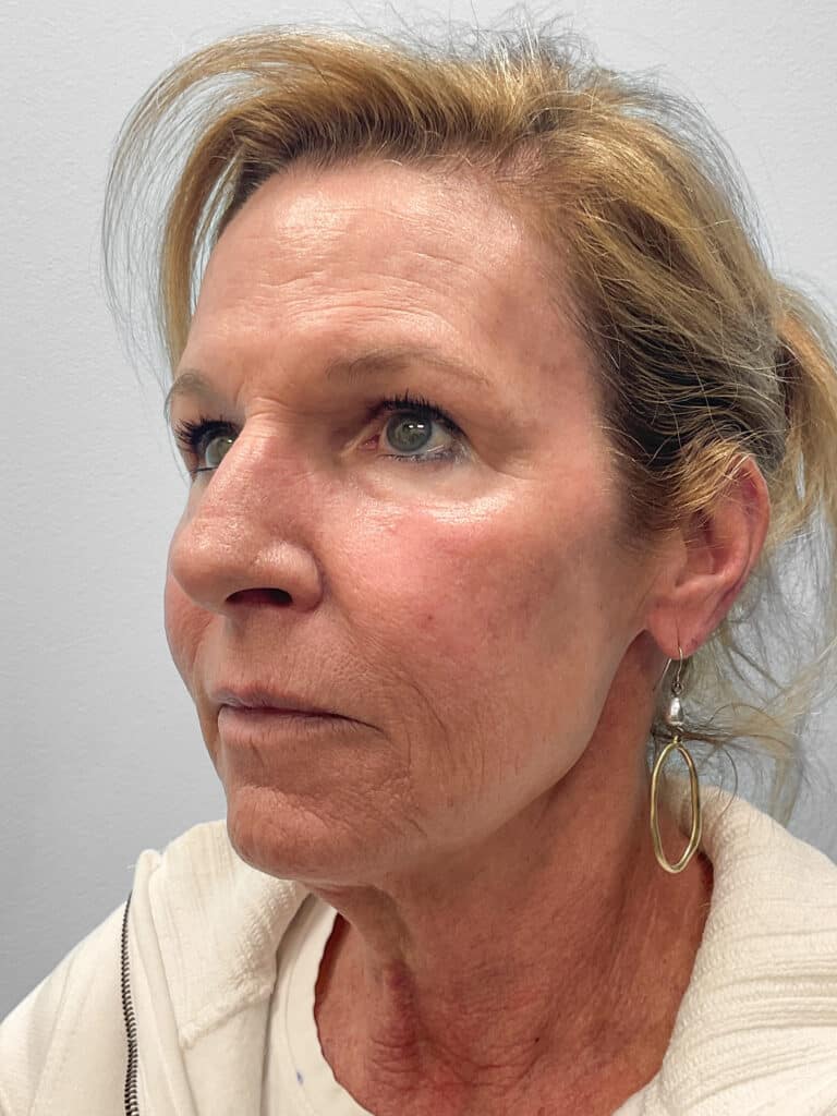 After Image: Laser Resurfacing – Dr. Tucker - left-front-oblique