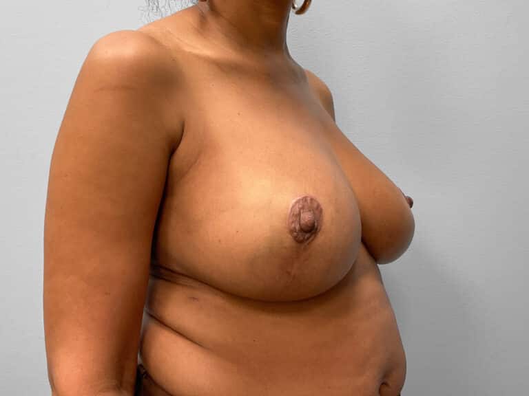 After Image: Breast Reduction – Dr. Tucker - right-front-oblique